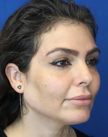 after chin filler right view female patient case 18652