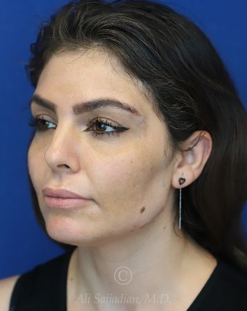 after chin filler left view female patient case 18652