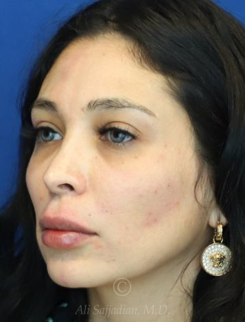 after lip filler left view female patient case 18672