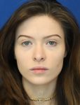 before lip filler front view female patient case 18675