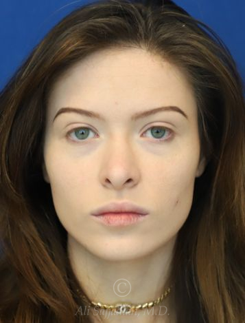 before lip filler front view female patient case 18675