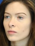 before lip filler left view female patient case 18675