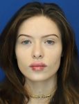 after lip filler front view female patient case 18675