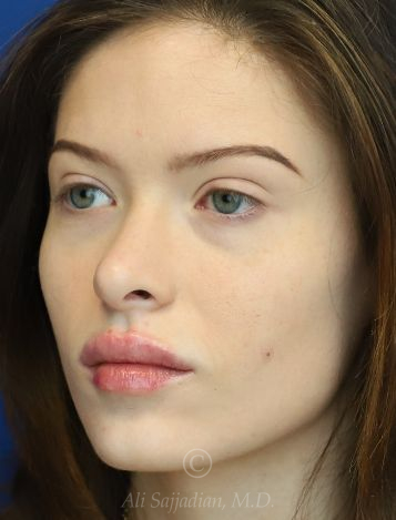 after lip filler left view female patient case 18675