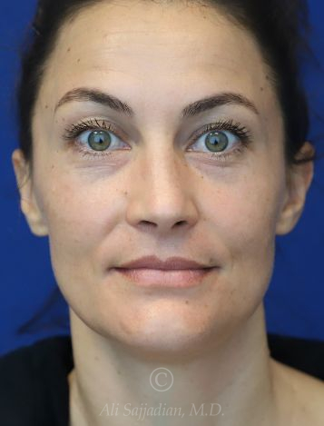 before lip filler front view female patient case 18680