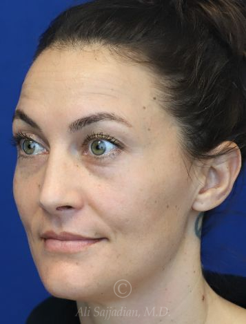 before lip filler left view female patient case 18680