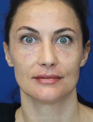 after lip filler front view female patient case 18680