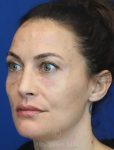 after lip filler left view female patient case 18680