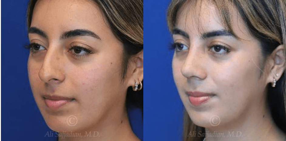 What is Hispanic Rhinoplasty? | Newport Beach | Dr. Ali Sajjadian