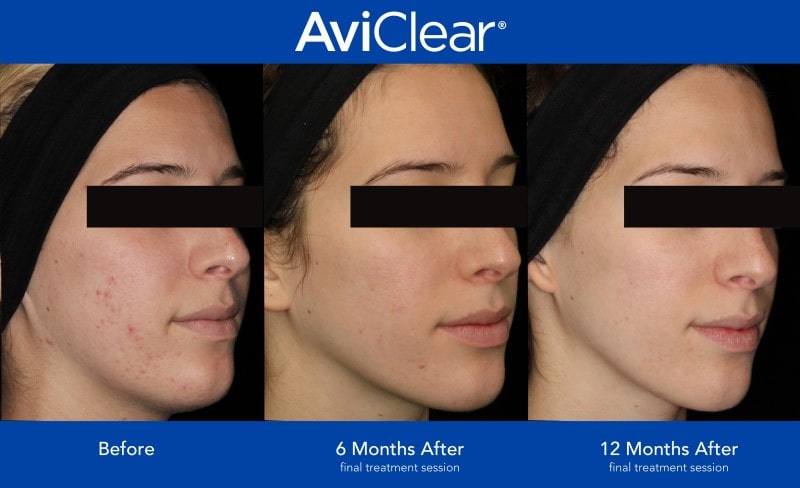 AviClear 6R-min