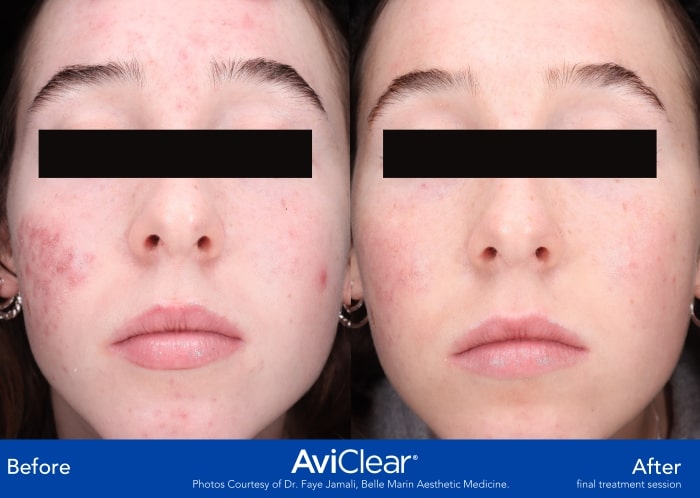 AviClear B_A front-min