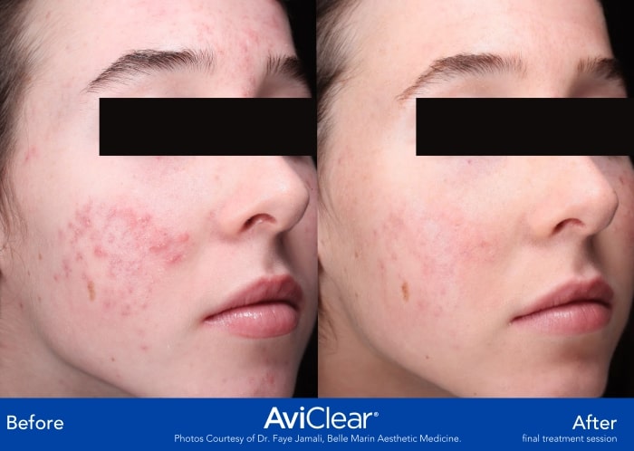 AviClear B_A side1-min