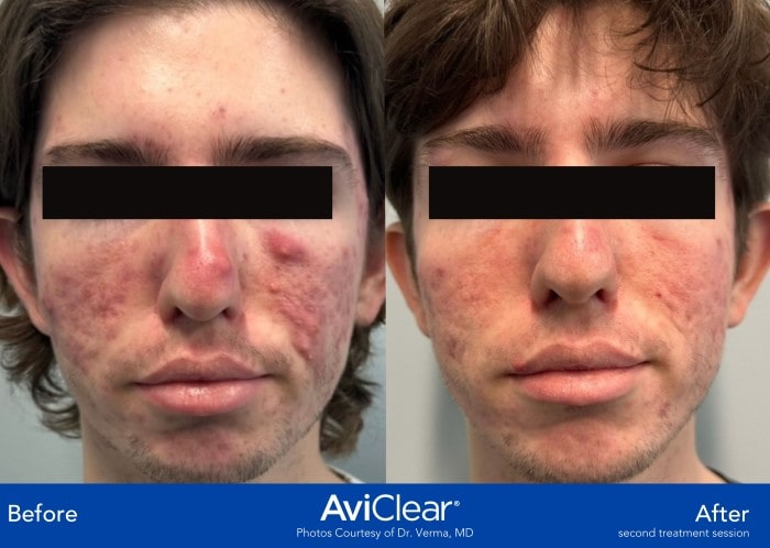 AviClear Before and After Template (2 images)-min