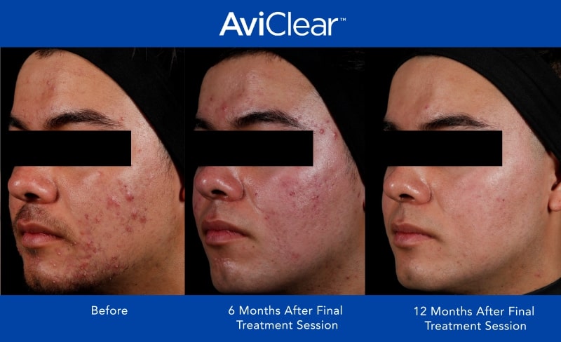 AviClear Before and After Template_12 month_2-min