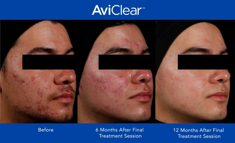 AviClear Before and After _12 month_1-min