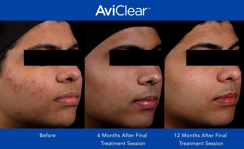 AviClear Before and After _12 month_3-min