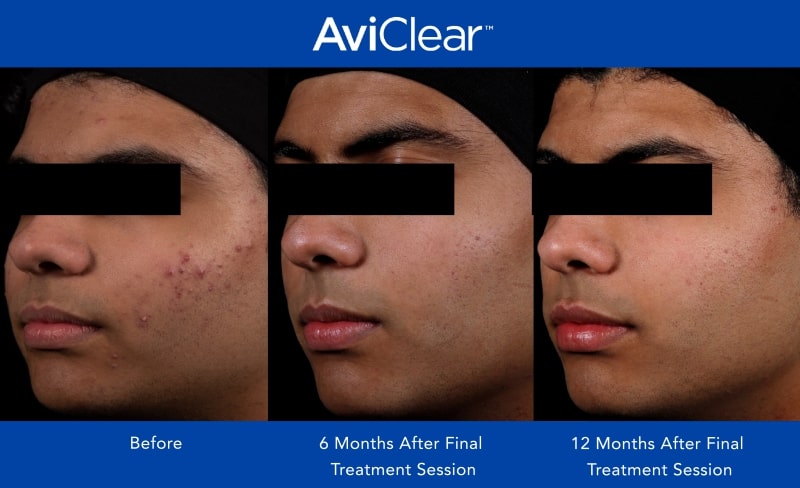 AviClear Before and After _12 month_4-min