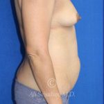 before mommy makeover right side view female patient case 20348