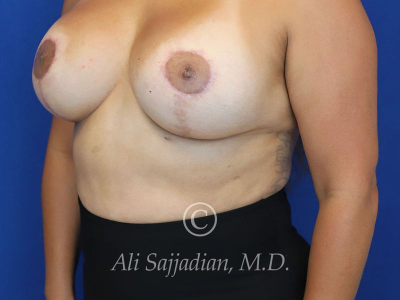 after revision breast augmentation left angle view female patient case 20325