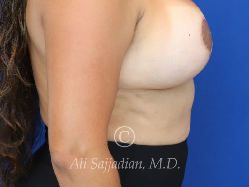 after revision breast augmentation right side view female patient case 20325