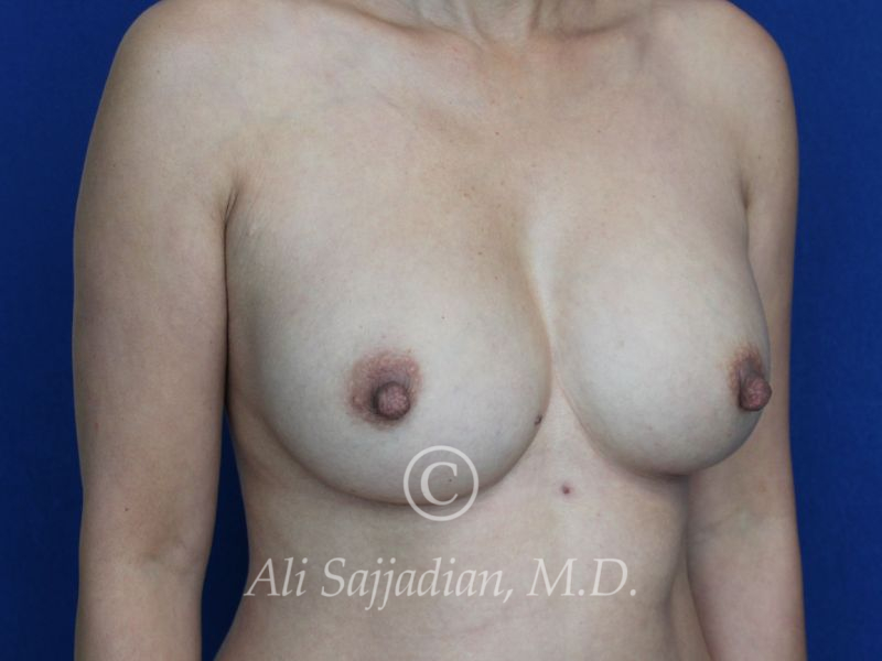 before revision breast augmentation right angle view female patient case 20337