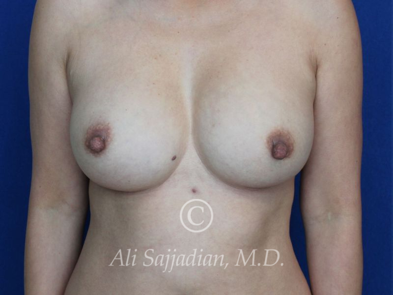 before revision breast augmentation front view female patient case 20337