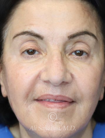after chemical peel front view female patient case 20422
