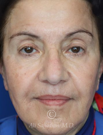 before chemical peel front view female patient case 20422