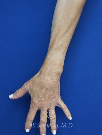 before hand filler top left hand view female patient case 20425
