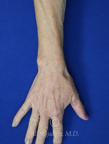 after hand filler top right hand view female patient case 20425