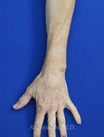 after hand filler top left hand view female patient case 20425