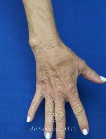 before hand filler top right hand view female patient case 20425