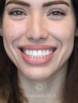 before gummy smile front view female patient case 20430