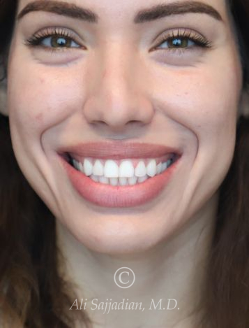 before gummy smile front view female patient case 20430