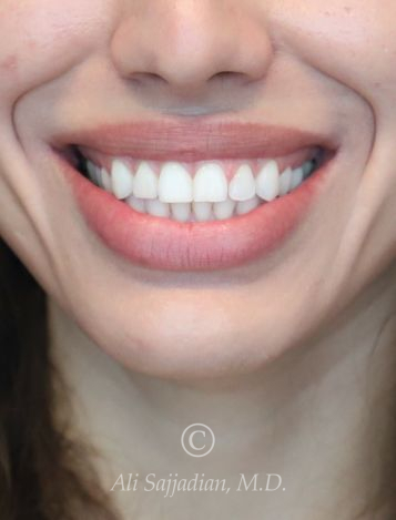 before gummy smile front close up mouth view female patient case 20430