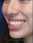 before gummy smile left angle close up mouth view female patient case 20430