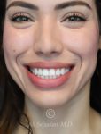 after gummy smile front view female patient case 20430