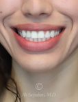 after gummy smile front close up mouth view female patient case 20430