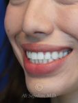after gummy smile left angle close up mouth view female patient case 20430