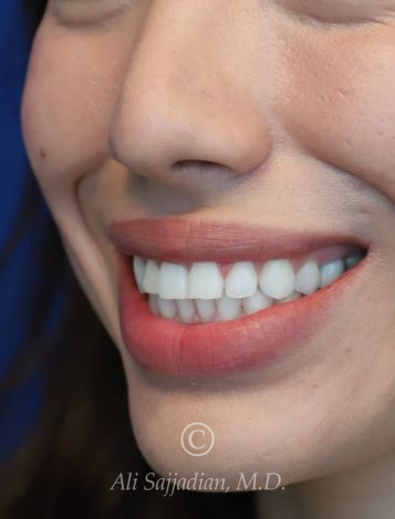 after gummy smile left angle close up mouth view female patient case 20430