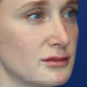 after lip filler right angle view female patient case 20441