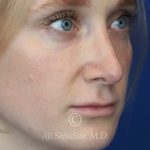 before lip filler right angle view female patient case 20441