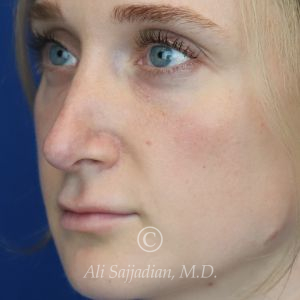 before lip filler left angle view female patient case 20441