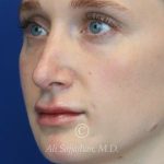 after lip filler left angle view female patient case 20441