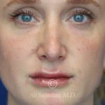 after lip filler front view female patient case 20441