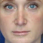 before lip filler front view female patient case 20441
