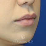 before lip filler right angle close up mouth view female patient case 20448