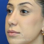 before lip filler left angle view female patient case 20448