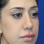 after lip filler right angle view female patient case 20448