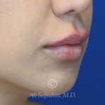 after lip filler right angle close up mouth view female patient case 20448